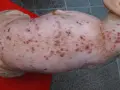 Piel de perro con sarna, mostrando erupciones y costras. La sarna de los perros se pega a los humanos, causando picazón e irritación.