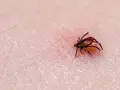 Garrapata de perro, con su cabeza dentro de la piel, lista para alimentarse.