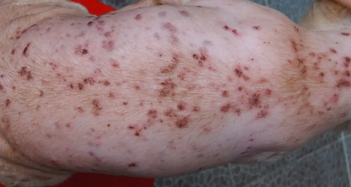 Piel de perro con sarna, mostrando erupciones y costras. La sarna de los perros se pega a los humanos, causando picazón e irritación.