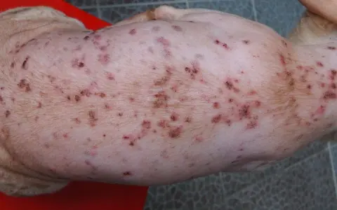 Piel de perro con sarna, mostrando erupciones y costras. La sarna de los perros se pega a los humanos, causando picazón e irritación.