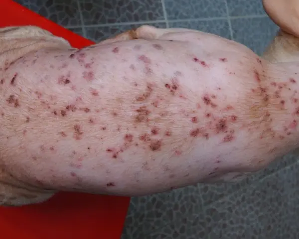 Piel de perro con sarna, mostrando erupciones y costras. La sarna de los perros se pega a los humanos, causando picazón e irritación.