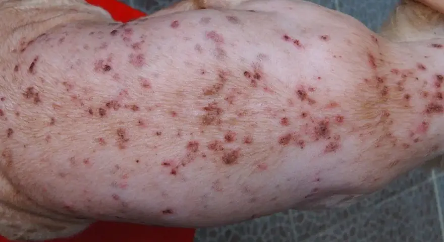 Piel de perro con sarna, mostrando erupciones y costras. La sarna de los perros se pega a los humanos, causando picazón e irritación.